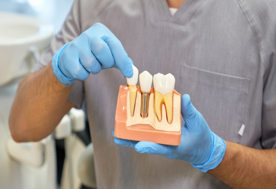 Dental Implants