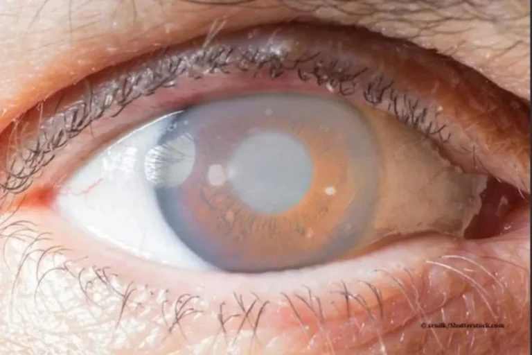 Can Glaucoma Be Cured? Understanding Treatment Goals